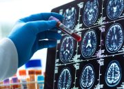 Tes Darah untuk Alzheimer Ada Di Sini