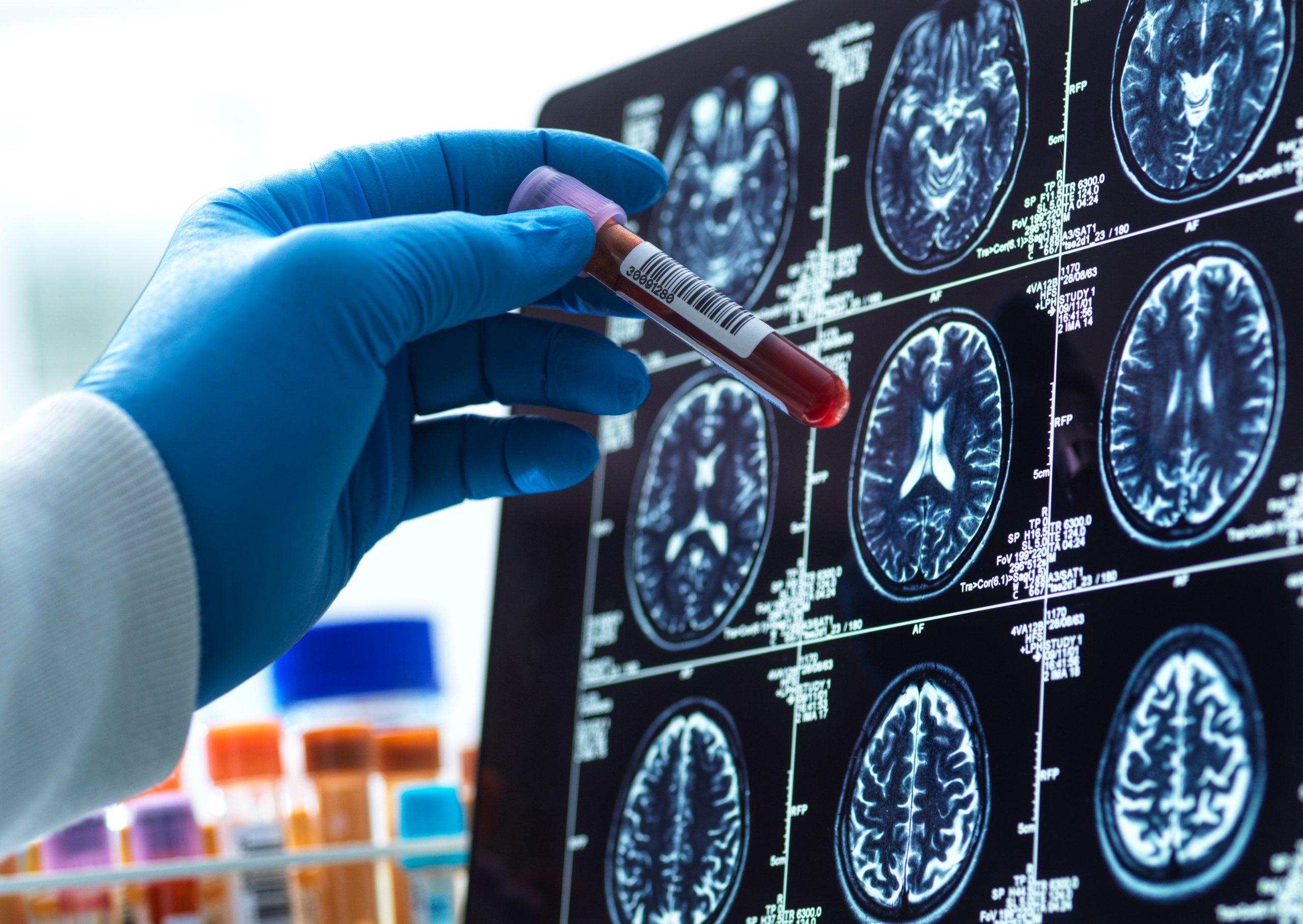 tes-darah-untuk-alzheimer-ada-di-sini