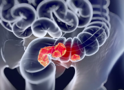 kasus-kanker-usus-usia-muda-naik,-peneliti-temukan-jejak-herbisida-di-dna