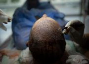 Bagaimana Turki Meretas Industri Transplantasi Rambut