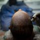 bagaimana-turki-meretas-industri-transplantasi-rambut