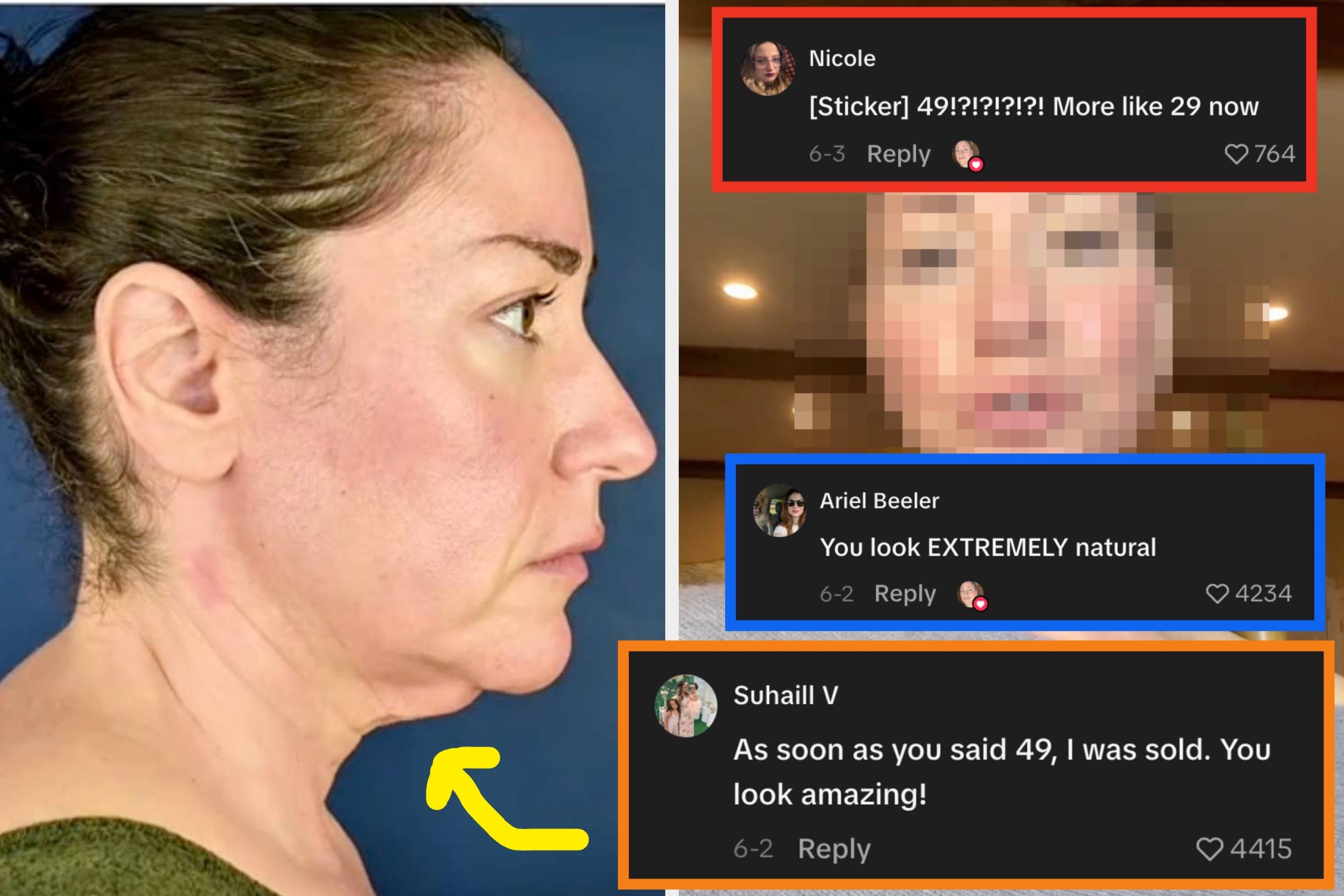 “apakah-saya-ingin-facelift?-tidak.-apakah-saya-ingin-melakukannya-sekarang?-ya”:-orang-orang-mengatakan-transformasi-wajah-wanita-49-tahun-ini-di-meksiko-mengakhiri-20-tahunnya,-dan-inilah-mengapa-perjalanannya-menjadi-begitu-viral