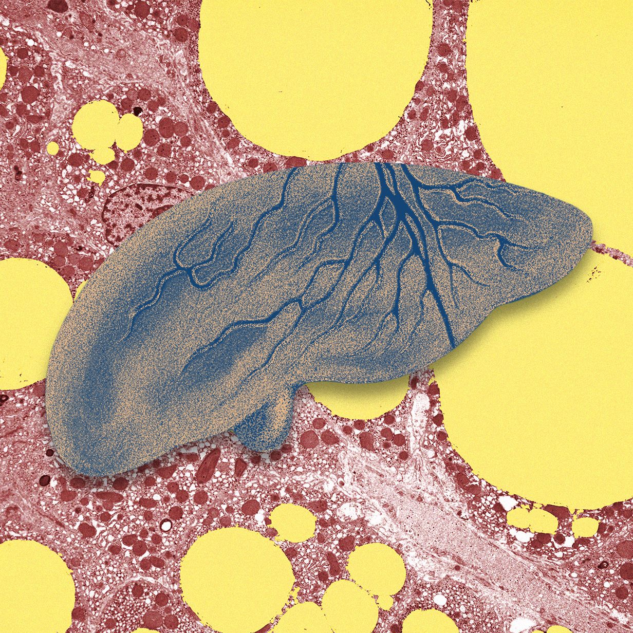 there’s-a-fatty-liver-epidemic.-ai-could-help-get-ahead-of-it