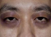 kenali-raccoon-eyes,-seperti-dibogem-tapi-ini-tanda-serius