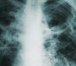 understanding-your-mesothelioma-treatment-options