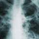 Understanding Your Mesothelioma Treatment Options